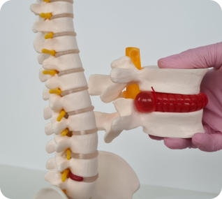 A doctor uses a model of a spine to show the bulge of a herniated disc