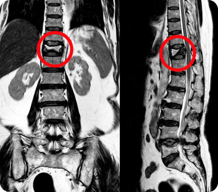 X-ray of a spine with a fracture. The fracture is circled in red.