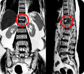 X-ray of a spine with a fracture. The fracture is circled in red.